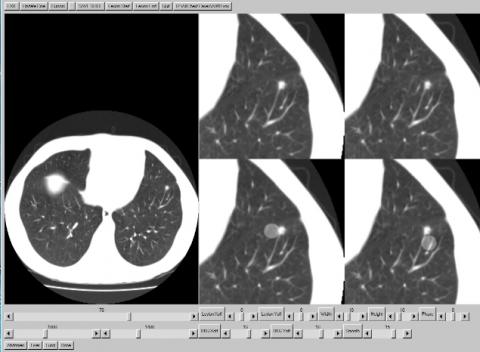 LesionRemovalProgram computer display showing a lesion on lung