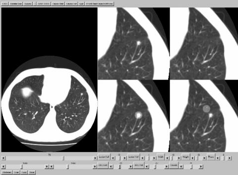 LesionRemovalProgram computer display showing removal of lesion on lung